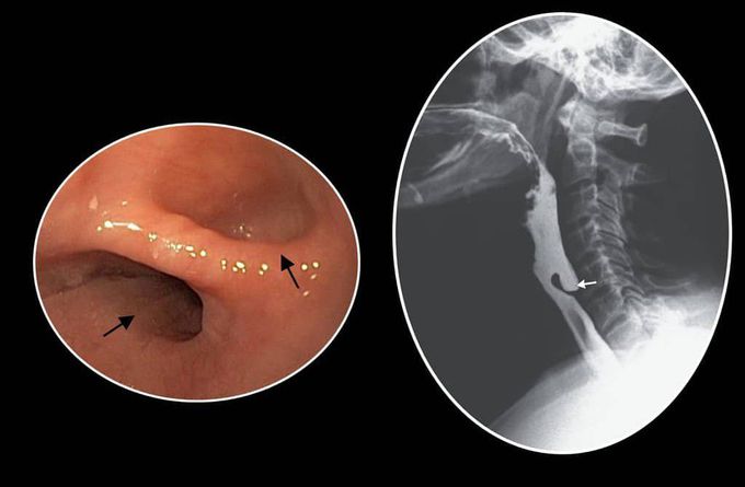 Zenker's diverticulum