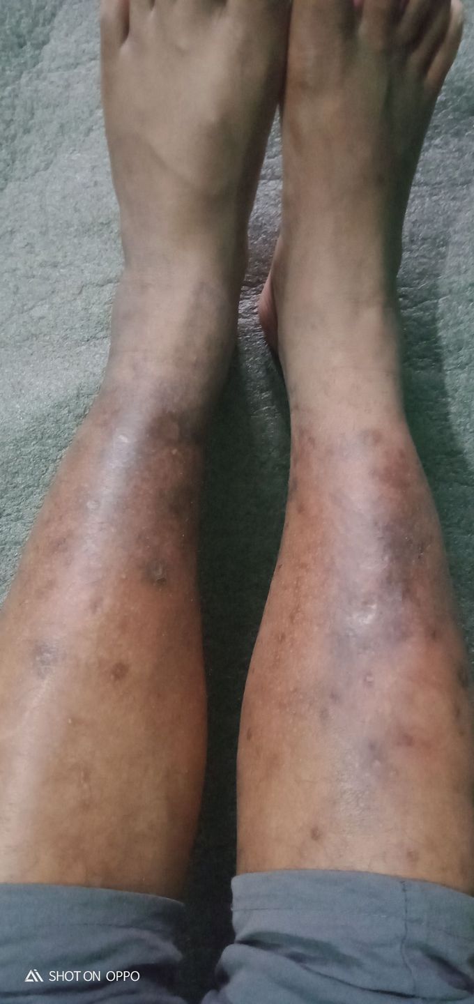 Case of Superficial thrombophlebitis