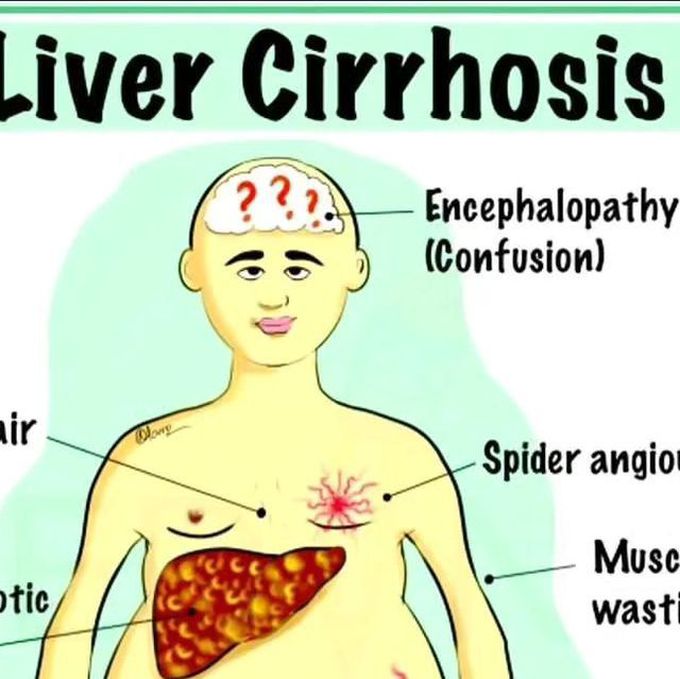 Cirrhosis