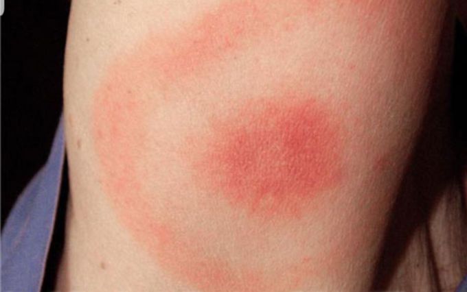 How is the treatment of this disease