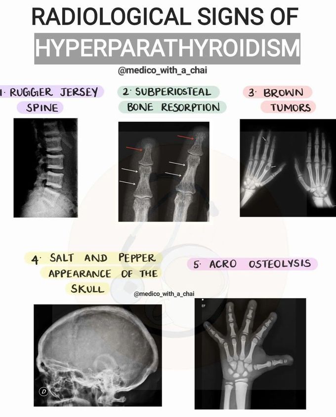 Radiology Signs of Hyperparathyroidism