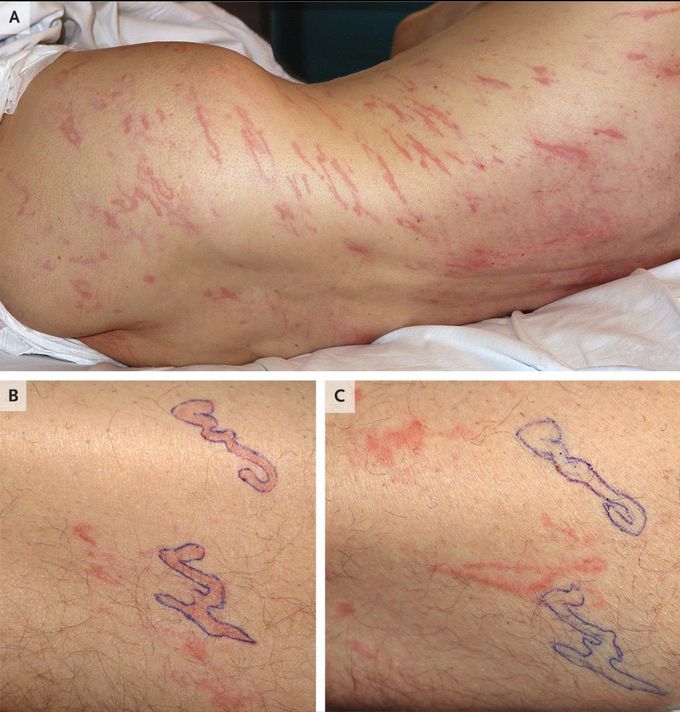 Larva Currens in Strongyloides Hyperinfection Syndrome