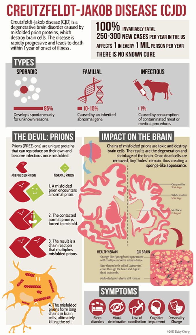 Creutzfeldt -Jacob Disease