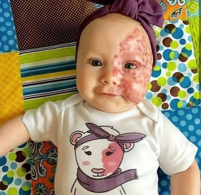 Sturge-Weber syndrome