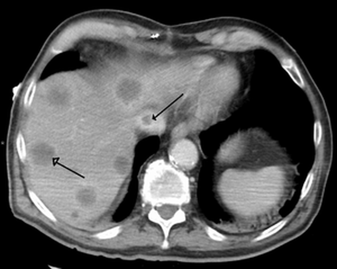 Budd–Chiari syndrome
