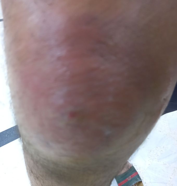 Knee swelling