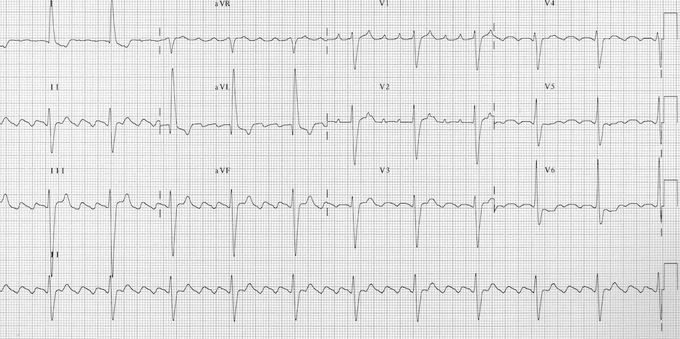 ECG Findings in Atrial Flutter