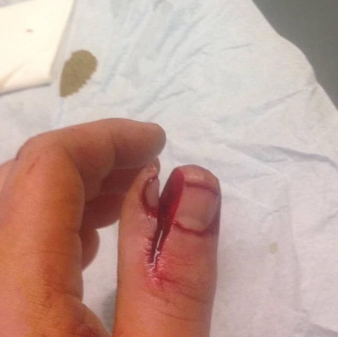 Case of a utility knife accident where the knife slipped and cut the patient deep into the thumb! 