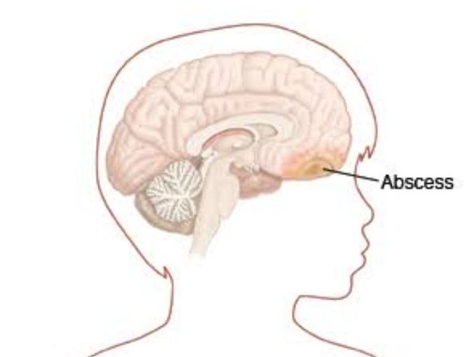 Brain abscess