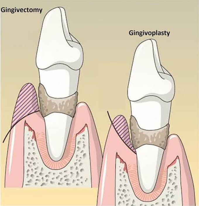 Gingivectomy vs gingivoplasty