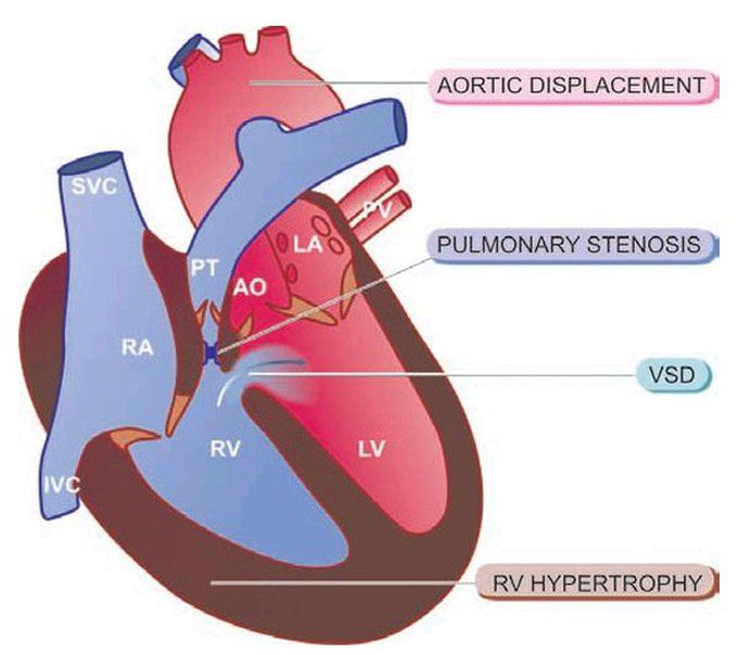 Tetralogy of Fallot