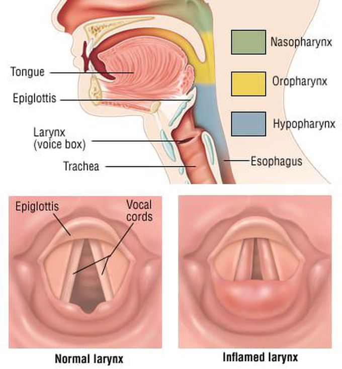 Laryngitis