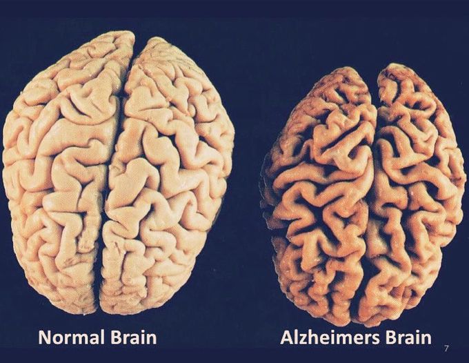 Normal brain vs. Alzheimers