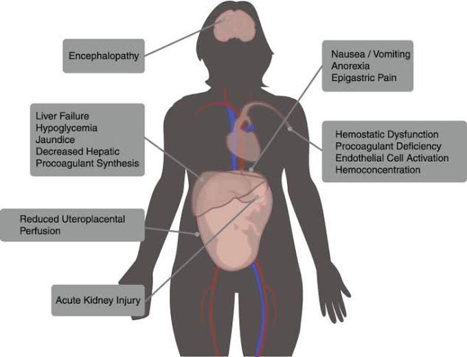 Acute Fatty Liver of Pregnancy (AFLP)