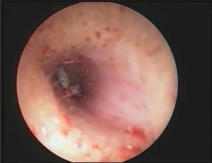 Fruit-fly Larva in the Auditory Canal & An Unusual Auricular Foreign Body