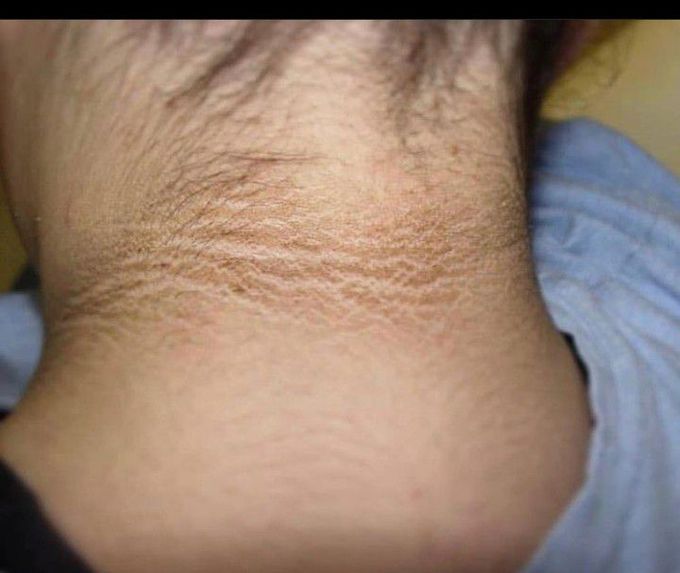 Acanthosis Nigricans