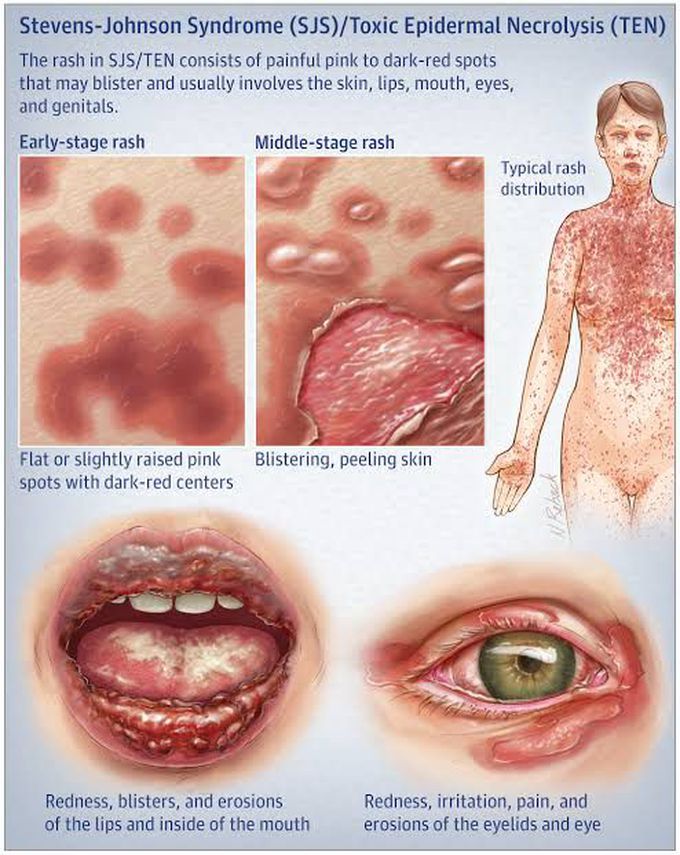 Stevens Johnson Syndrome (SJS)/Toxic Epidermal Necrolysis