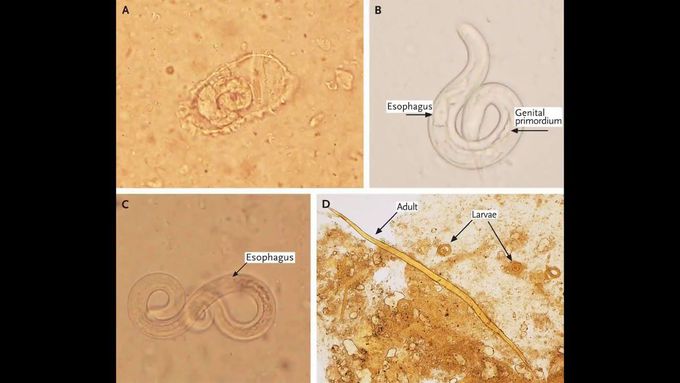 Sterongyloides stercoralis - morphology, life cycle, pathogenesis, diagnosis and treatment