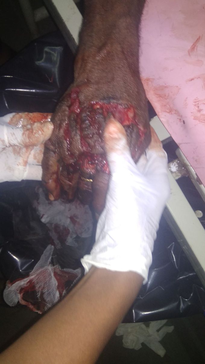 Patient came in casuality with complaint of hand crush injury due to sugarcane juice machine. There was a severe blood loss, patient was anxious. So He was given 500ml RL and Inj.TT. Patient need plastic surgery (skin grafting) and orthopaedic surgeon, For further treatment