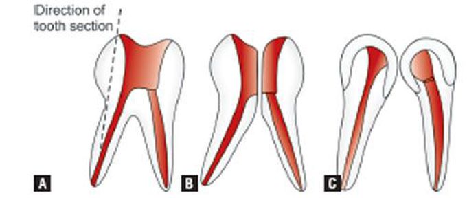 bicuspidization