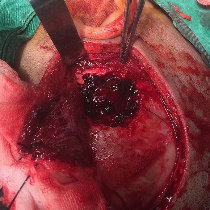 Epidural hematoma 
