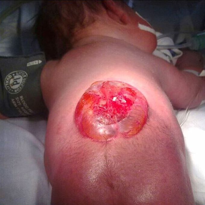 The lumbar region of a newborn baby with myelomeningocele