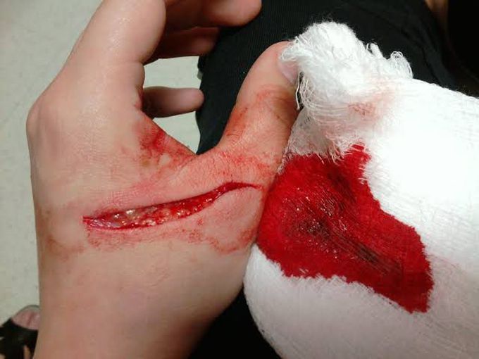 How to treat a laceration wound?