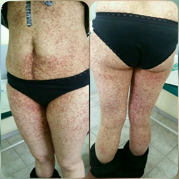 Urticaria pigmentosa
