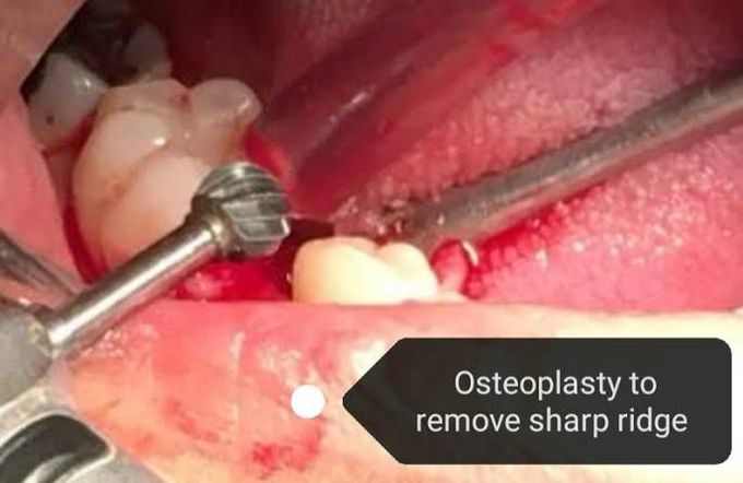 Osteoplasty