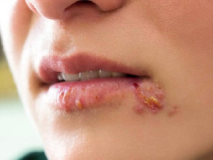 Herpes