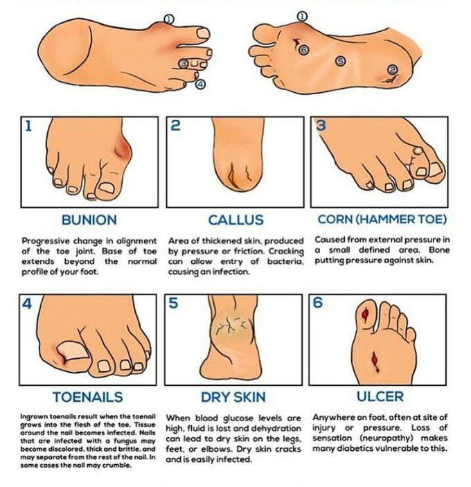 Diabetic Foot