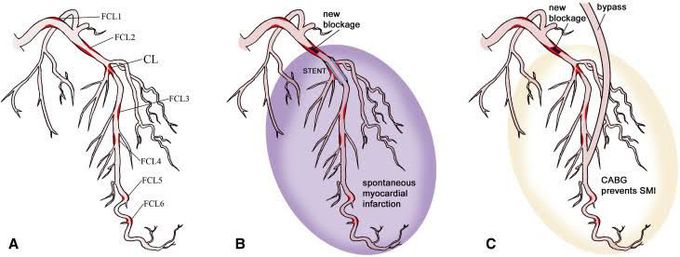 Spontaneous myocardial infarction