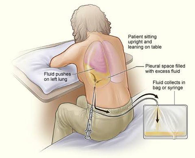 Thoracentesis