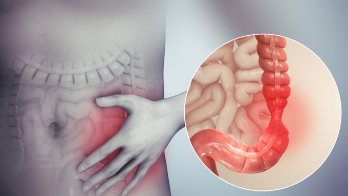 Diagnosis of Irritable bowel syndrome