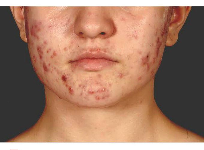 Acne Vulgaris