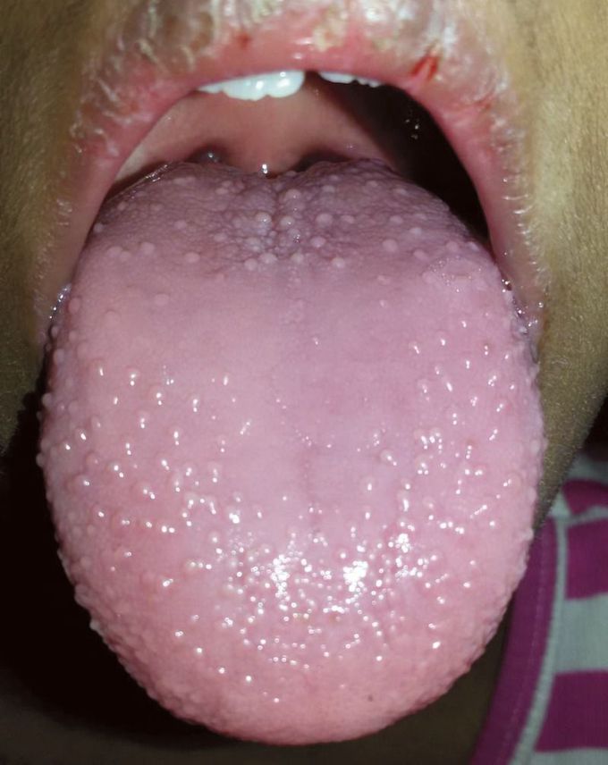 Strawberry Tongue