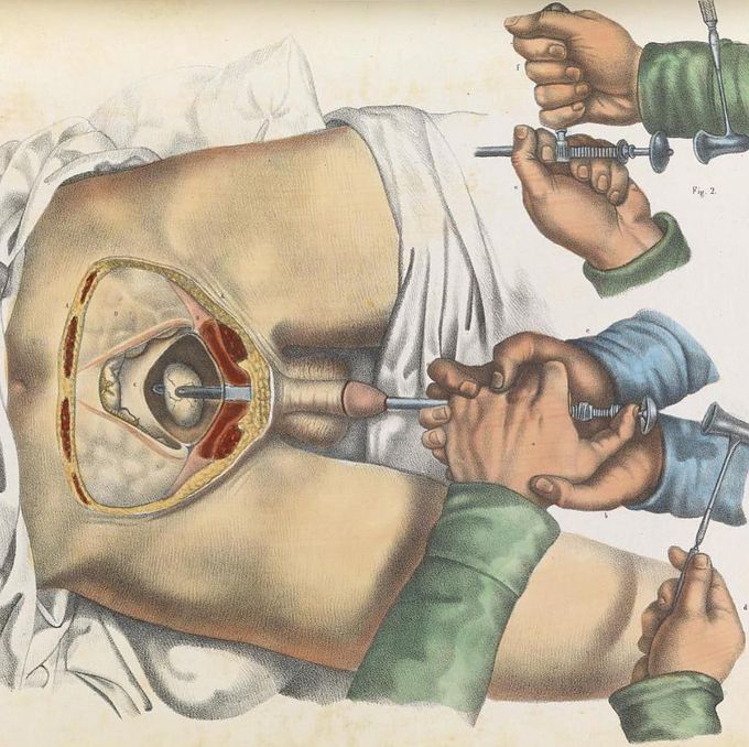 Lithotripsy
