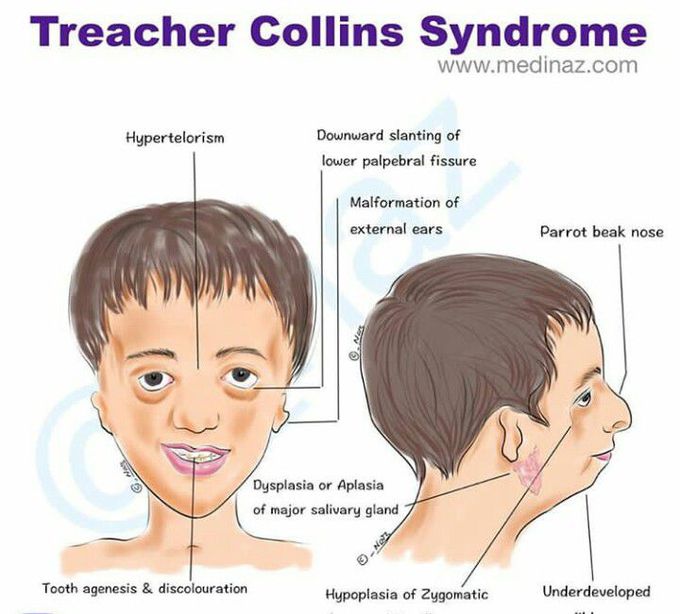 Trechere collin syndrome