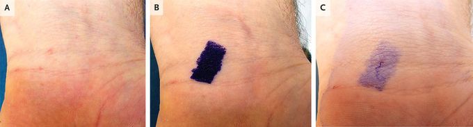 Burrow Ink Test for Scabies