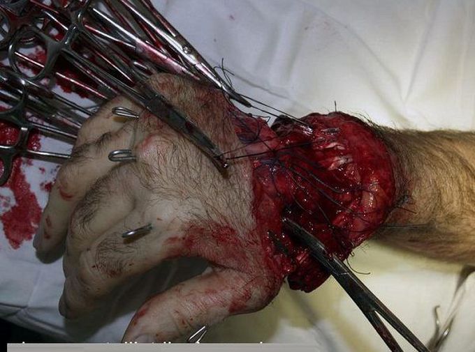 Amputated Hand Re-Implantation Surgery