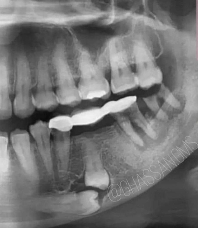 Anesthesia for Extraction