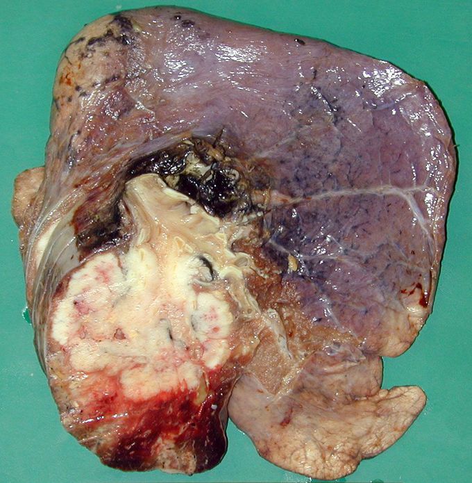 NON-SMALL CELL LUNG CANCER (NSCLC)