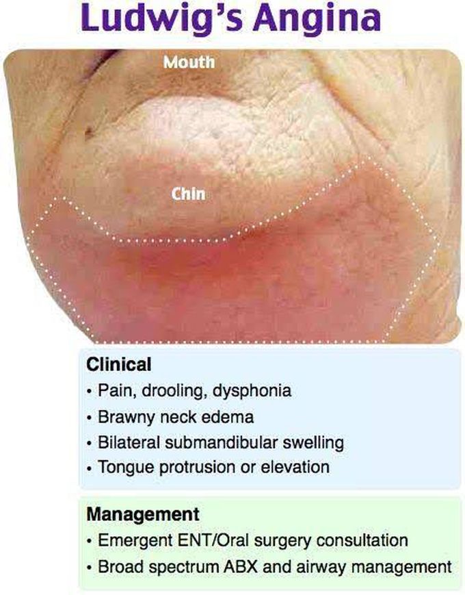 Ludwigs angina symptoms