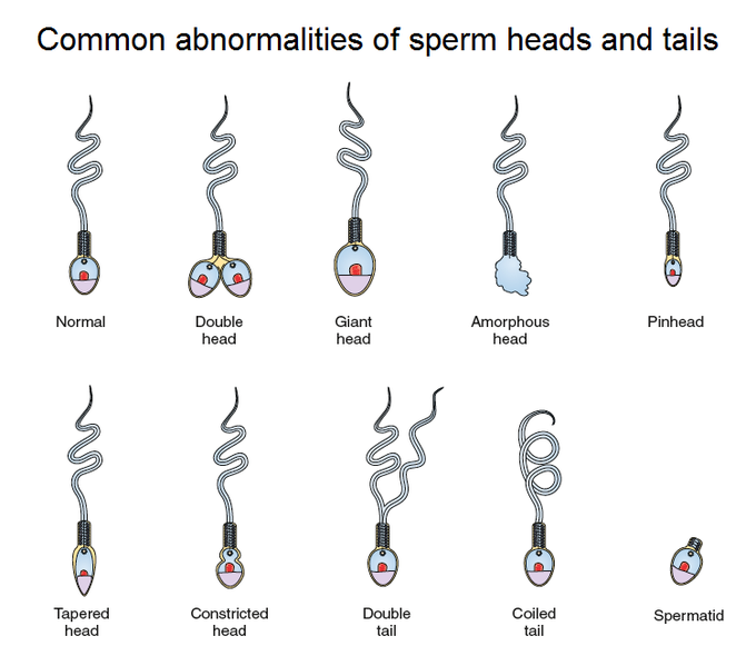 Abnormalities of Sperm Heads and Tails