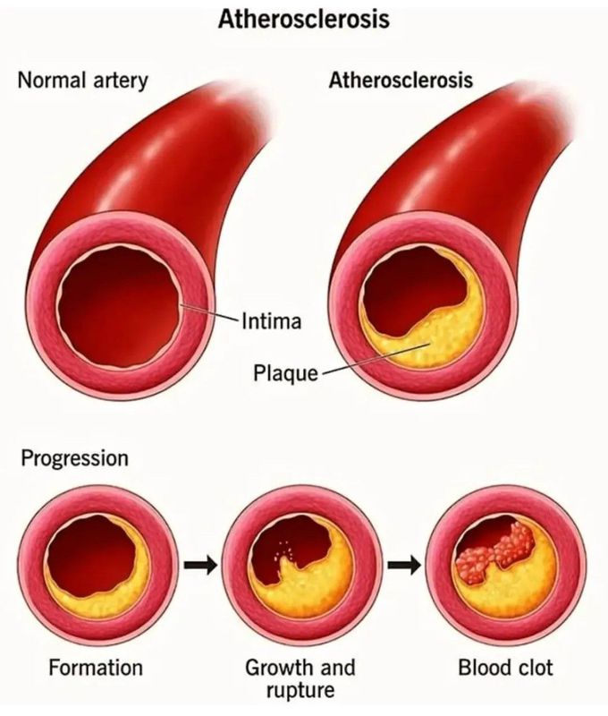 Atherosclerosis