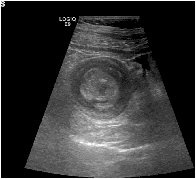 Doughnut Sign on ultrasound in a patient with Intussusception