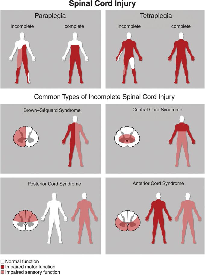 Spinal Cord Injury