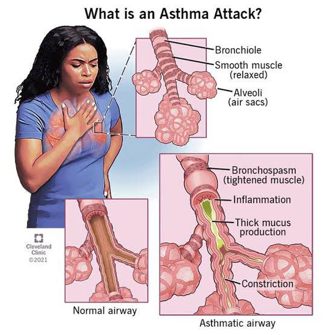 Asthma Attack: pathophysiology