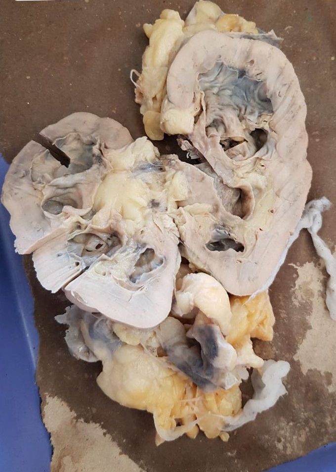 Chronic pyelonephritis