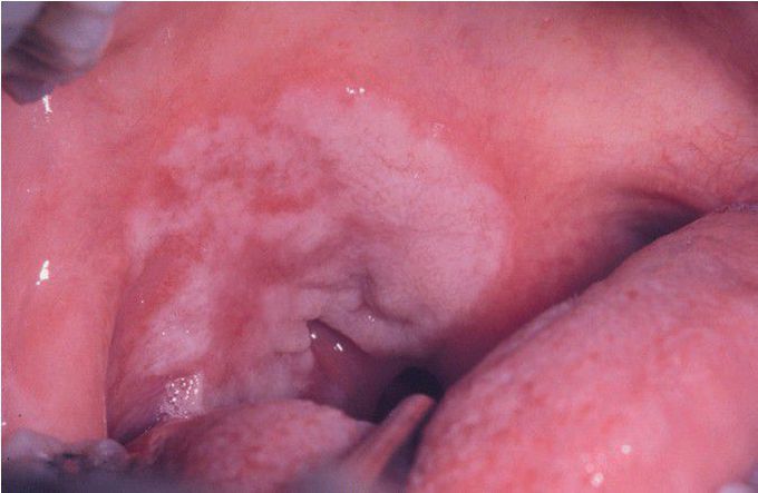 Mucous Patch of Secondary Syphilis.